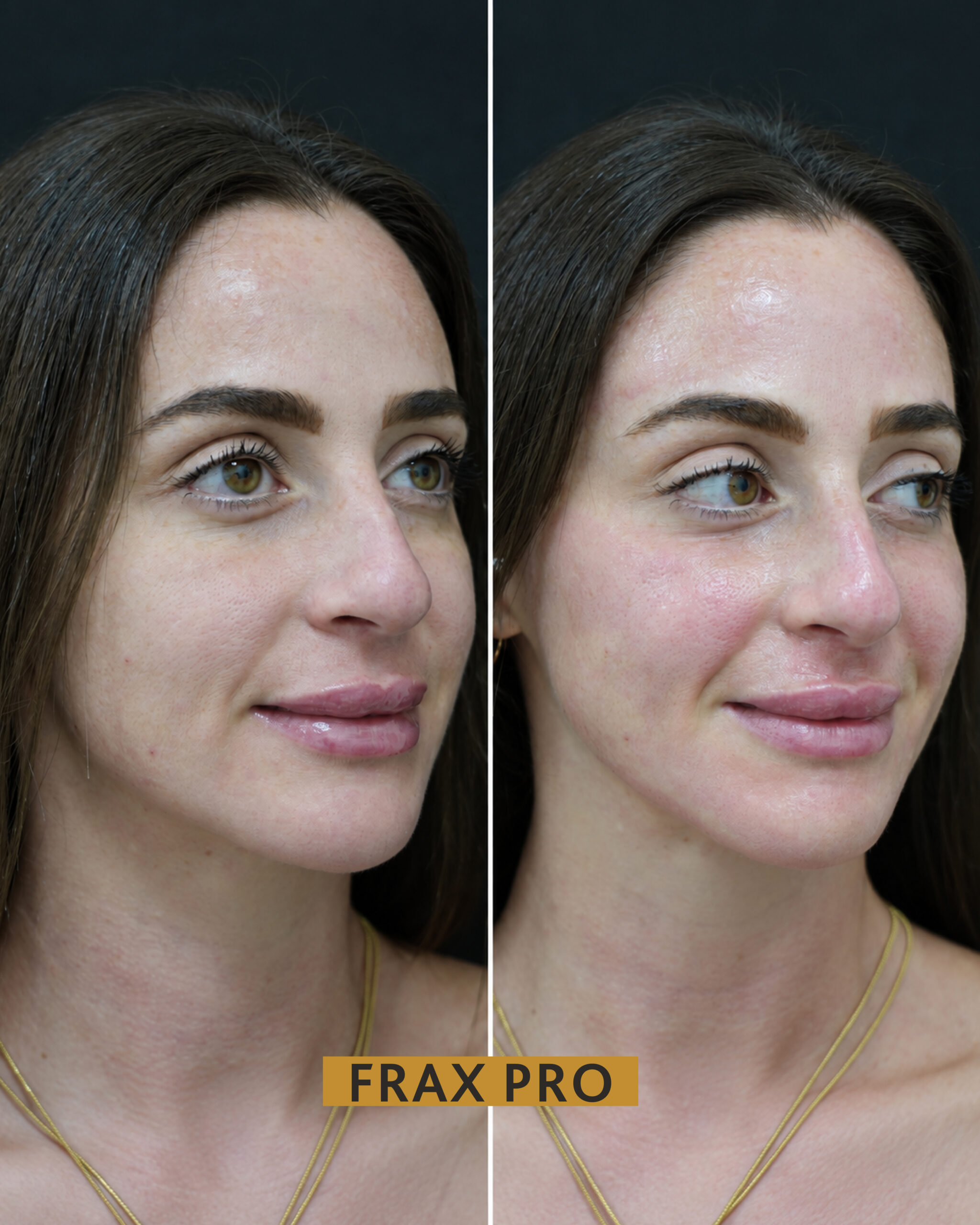 frax pro BNA-01