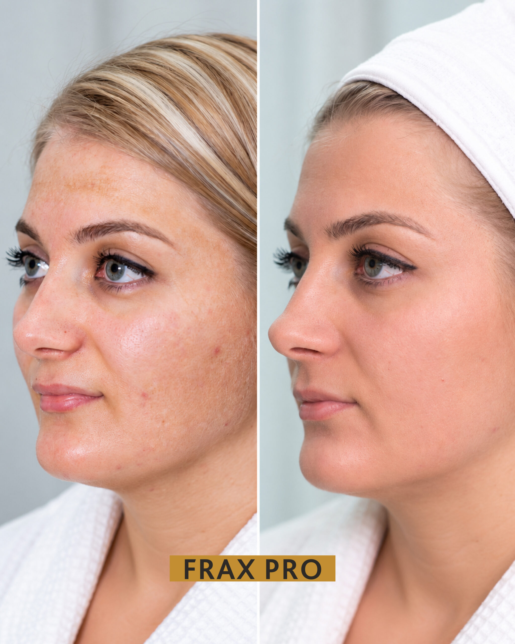 frax pro BNA-02