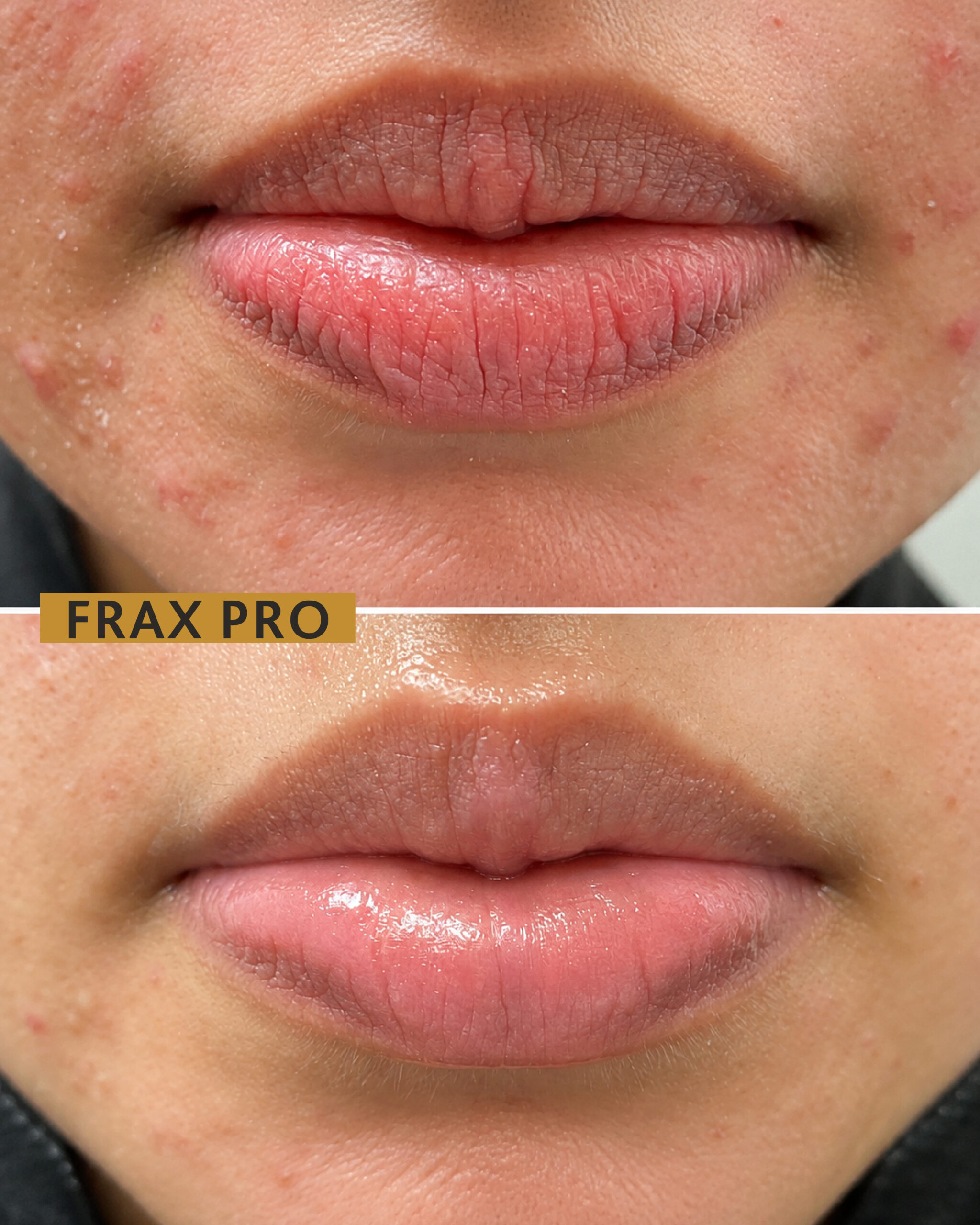 frax pro BNA-03