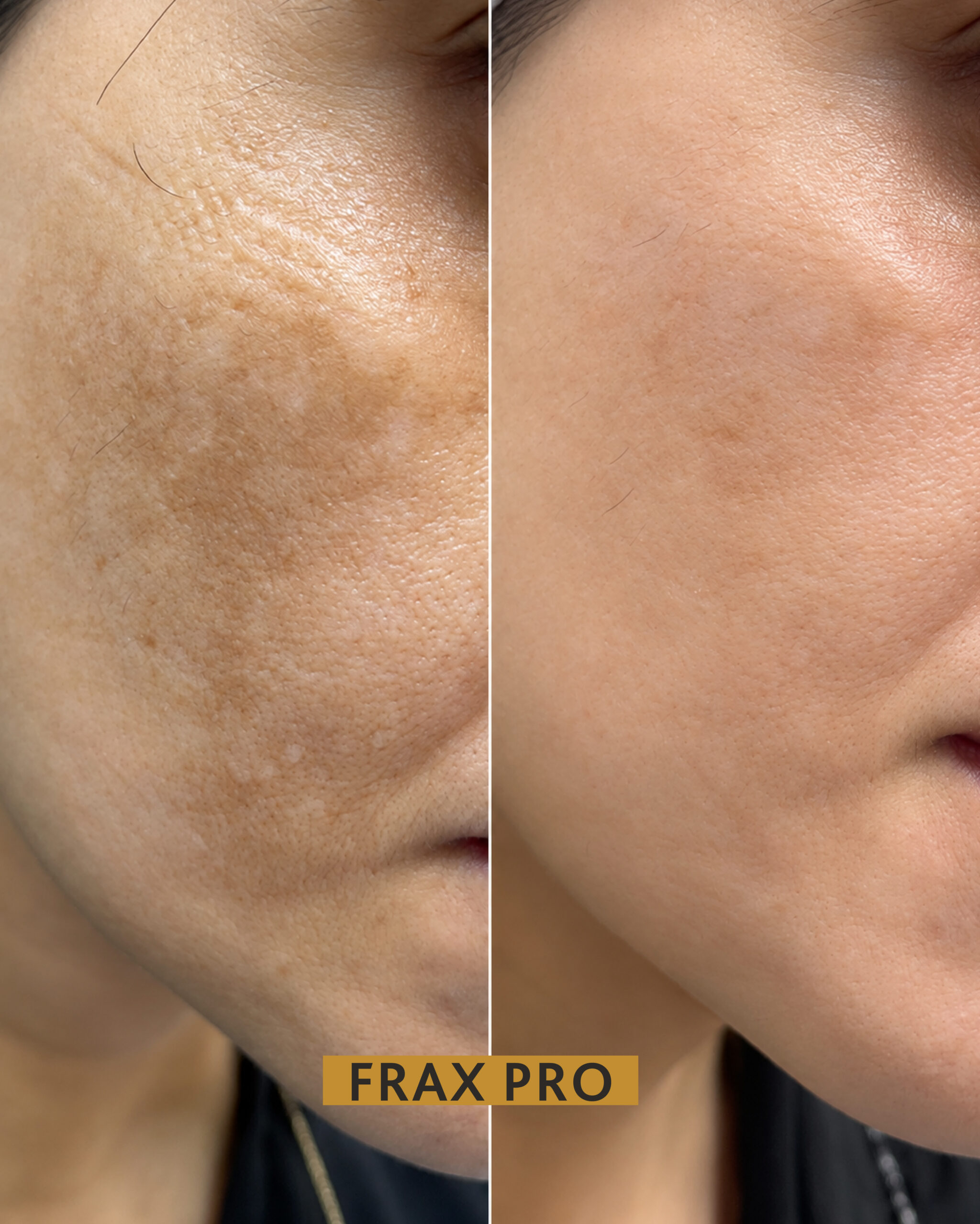 frax pro BNA-04