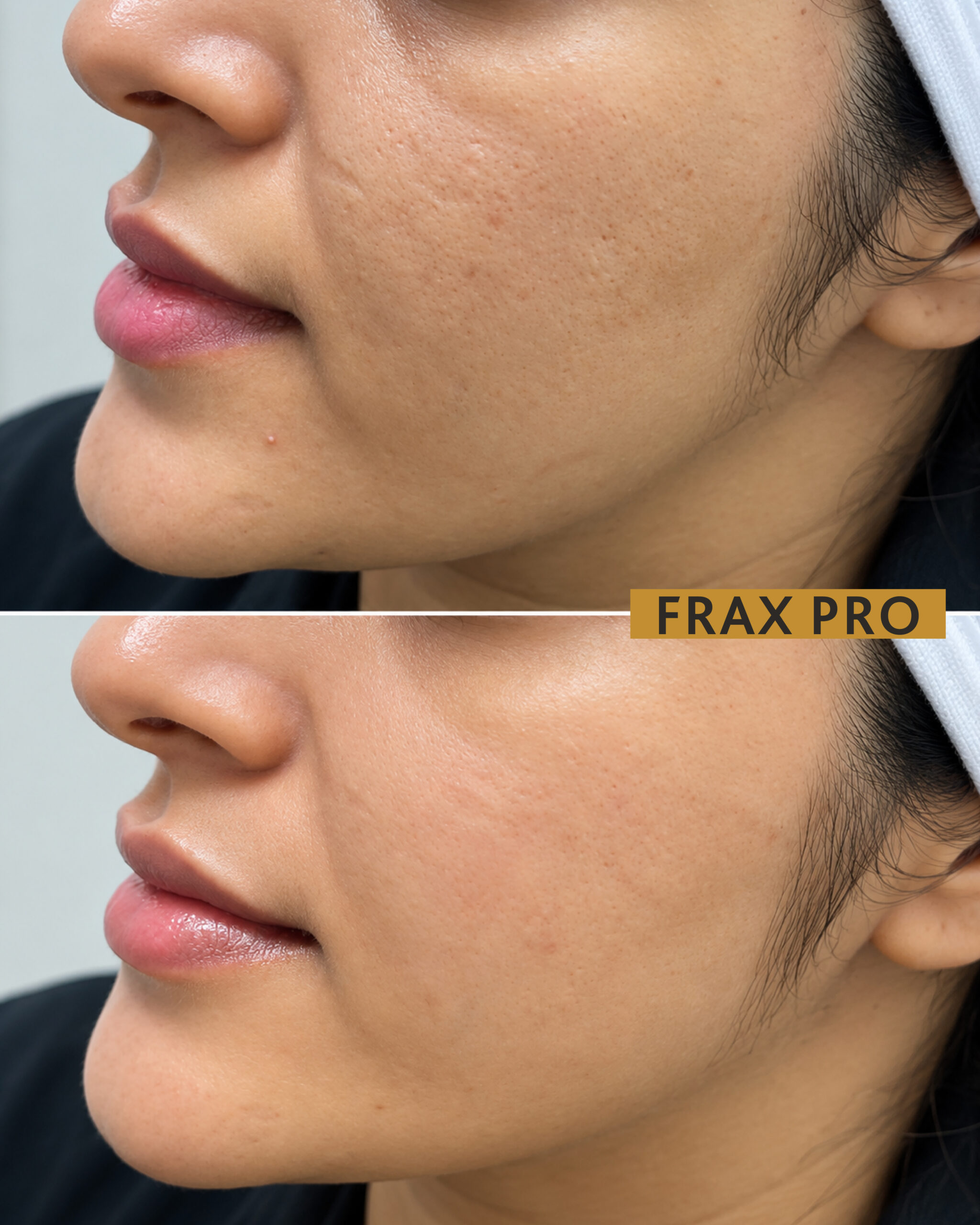 frax pro BNA-05